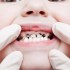 ما هو تسوس الاسنان