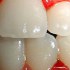 ما هو علاج التهاب لثة الأسنان