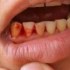 أسباب خروج الدم من الفم