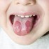 علاج الفطريات في الفم