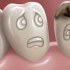 علاج تسوس الأسنان في المنزل