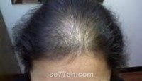 كسل الغدة الدرقية و أعراضه