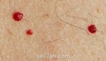 النخالة الوردية Pityriasis Rosea